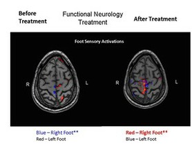 Brain changes associate with Carrick neurology brain treatment