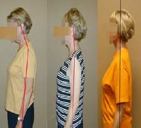 Chiropractic doctors in Pittsburgh fixing posture