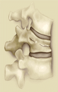 Pittsburgh Chiropractic Clinics Treat Kyphosis 